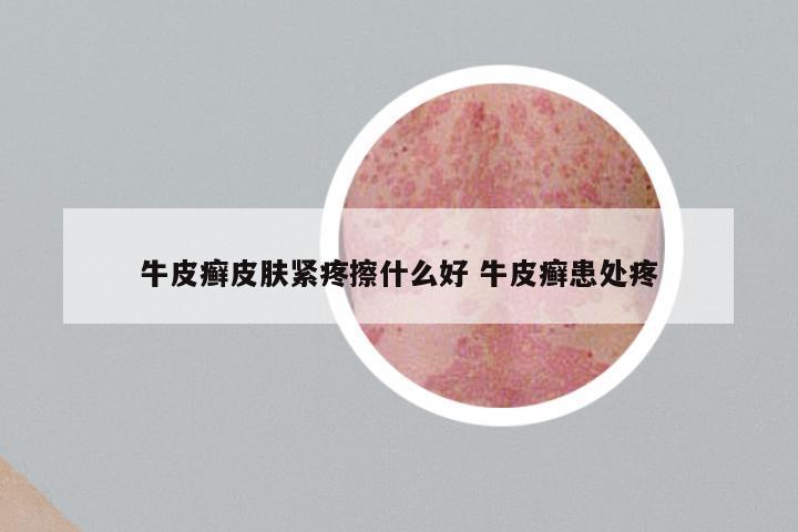 牛皮癣皮肤紧疼擦什么好 牛皮癣患处疼