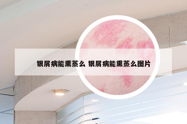 银屑病能熏蒸么 银屑病能熏蒸么图片