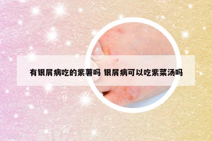 有银屑病吃的紫薯吗 银屑病可以吃紫菜汤吗
