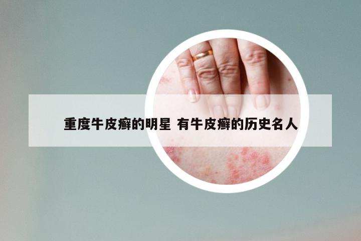 重度牛皮癣的明星 有牛皮癣的历史名人