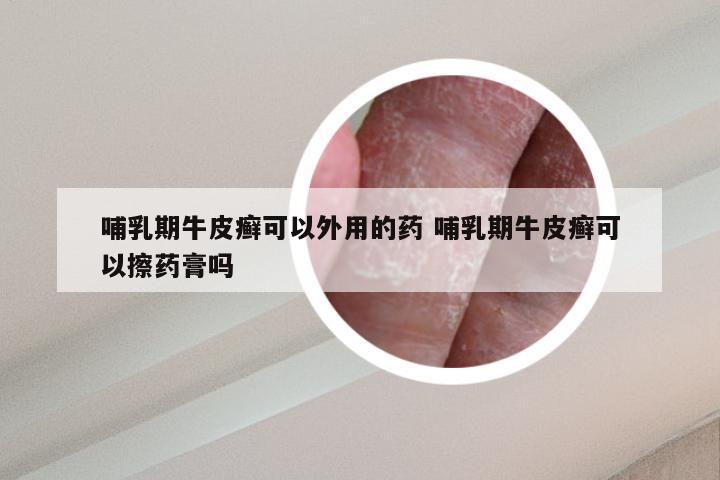 哺乳期牛皮癣可以外用的药 哺乳期牛皮癣可以擦药膏吗