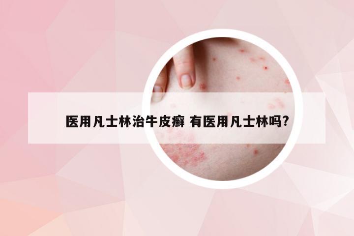 医用凡士林治牛皮癣 有医用凡士林吗?