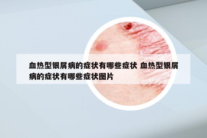血热型银屑病的症状有哪些症状 血热型银屑病的症状有哪些症状图片