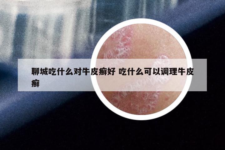 聊城吃什么对牛皮癣好 吃什么可以调理牛皮癣