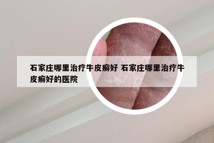 石家庄哪里治疗牛皮癣好 石家庄哪里治疗牛皮癣好的医院
