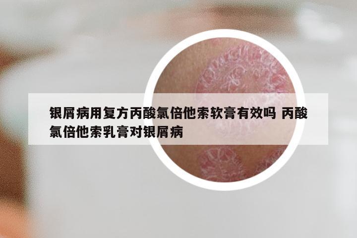 银屑病用复方丙酸氯倍他索软膏有效吗 丙酸氯倍他索乳膏对银屑病
