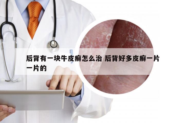 后背有一块牛皮癣怎么治 后背好多皮癣一片一片的