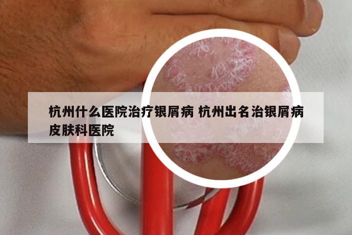 杭州什么医院治疗银屑病 杭州出名治银屑病皮肤科医院