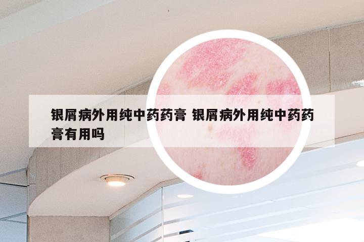 银屑病外用纯中药药膏 银屑病外用纯中药药膏有用吗