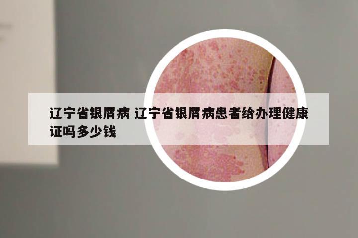 辽宁省银屑病 辽宁省银屑病患者给办理健康证吗多少钱