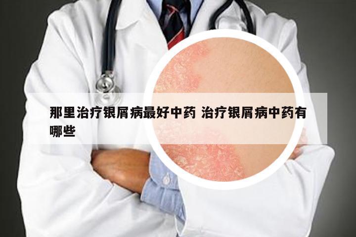 那里治疗银屑病最好中药 治疗银屑病中药有哪些