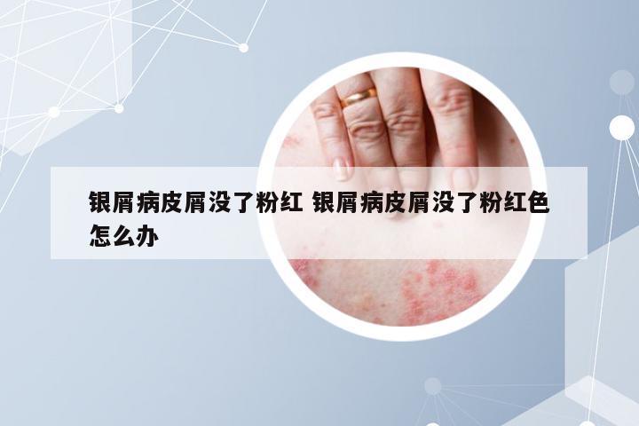 银屑病皮屑没了粉红 银屑病皮屑没了粉红色怎么办