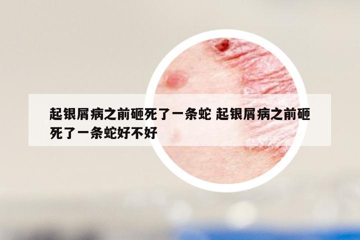 起银屑病之前砸死了一条蛇 起银屑病之前砸死了一条蛇好不好