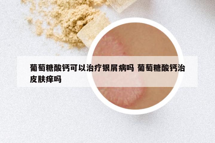 葡萄糖酸钙可以治疗银屑病吗 葡萄糖酸钙治皮肤痒吗