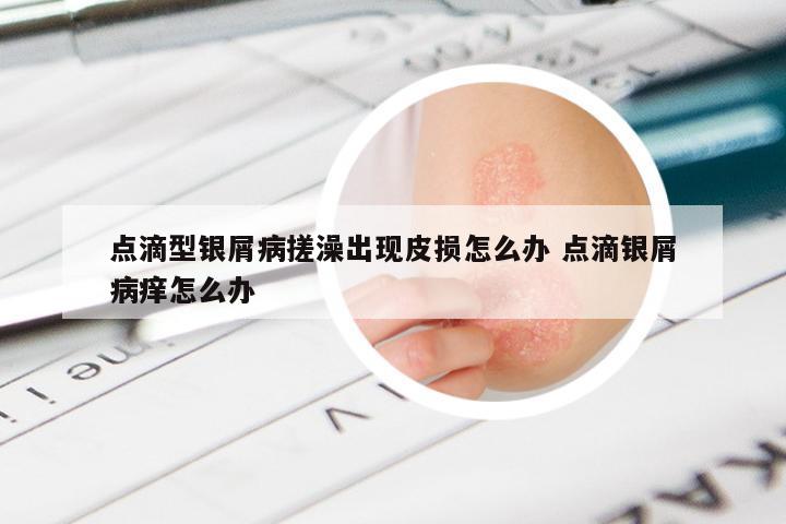 点滴型银屑病搓澡出现皮损怎么办 点滴银屑病痒怎么办