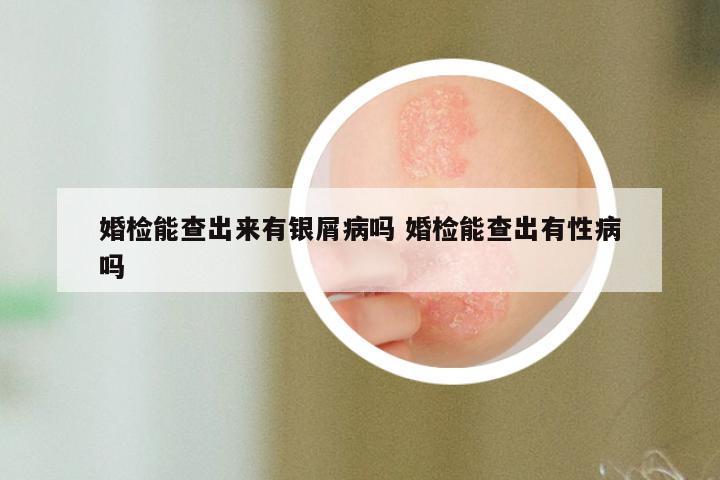 婚检能查出来有银屑病吗 婚检能查出有性病吗