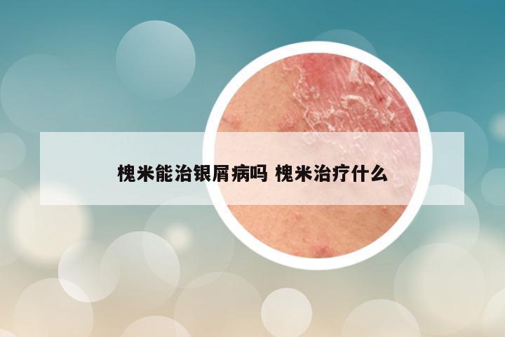 槐米能治银屑病吗 槐米治疗什么