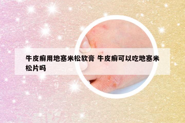 牛皮癣用地塞米松软膏 牛皮癣可以吃地塞米松片吗