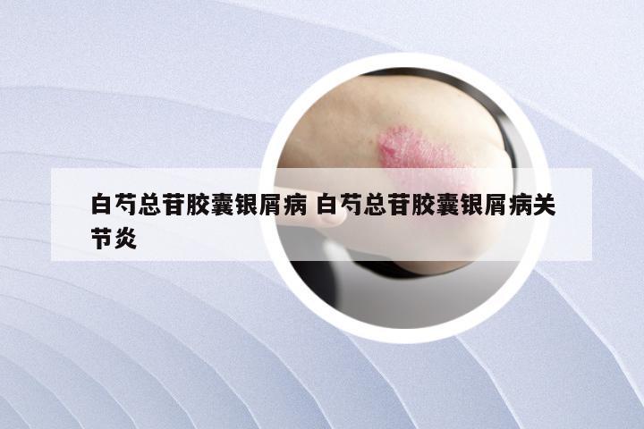 白芍总苷胶囊银屑病 白芍总苷胶囊银屑病关节炎