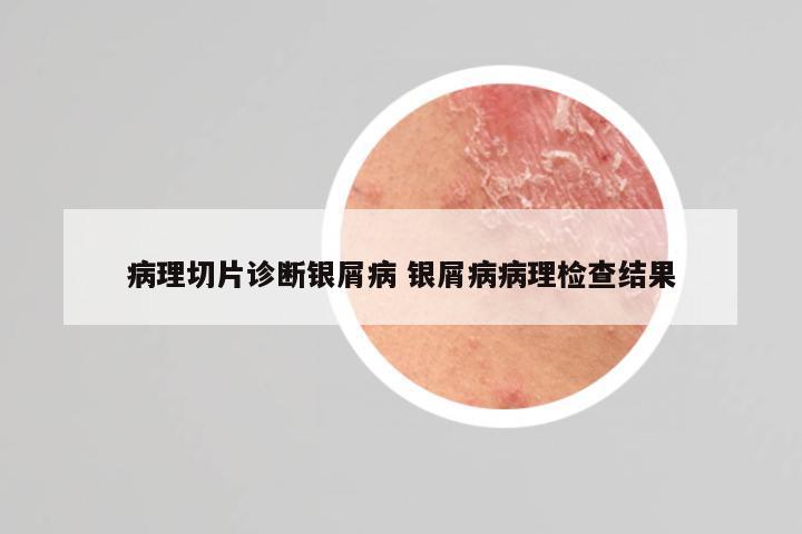 病理切片诊断银屑病 银屑病病理检查结果