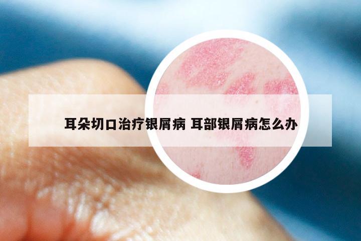 耳朵切口治疗银屑病 耳部银屑病怎么办