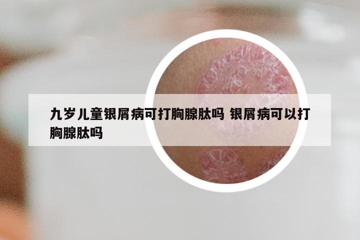 九岁儿童银屑病可打胸腺肽吗 银屑病可以打胸腺肽吗