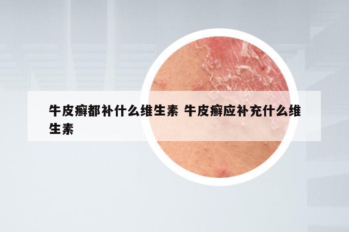 牛皮癣都补什么维生素 牛皮癣应补充什么维生素
