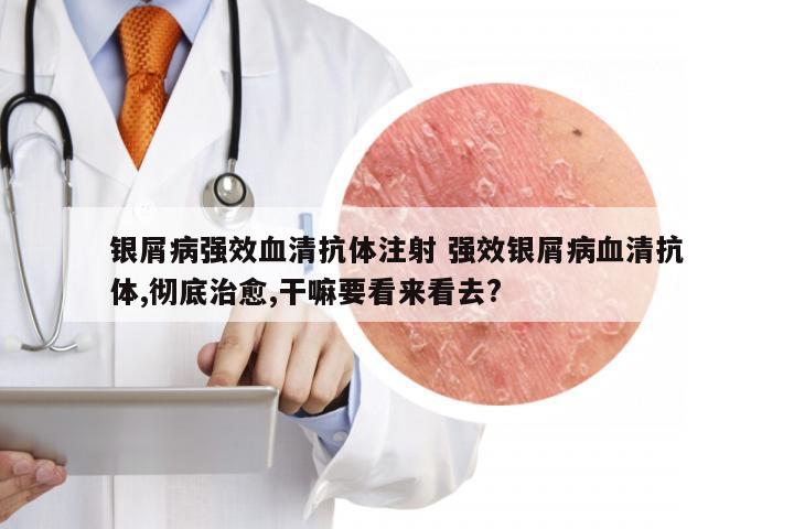 银屑病强效血清抗体注射 强效银屑病血清抗体,彻底治愈,干嘛要看来看去?