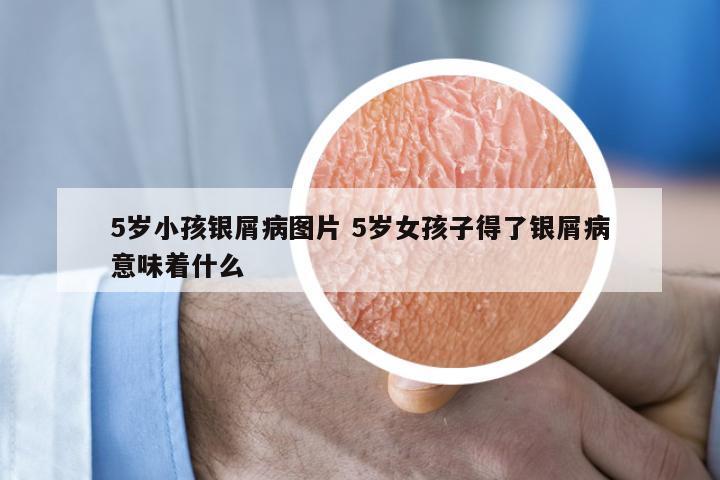 5岁小孩银屑病图片 5岁女孩子得了银屑病意味着什么