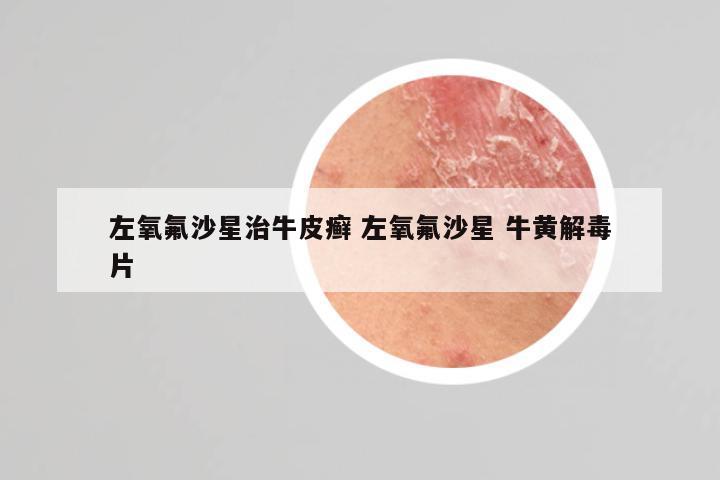 左氧氟沙星治牛皮癣 左氧氟沙星 牛黄解毒片