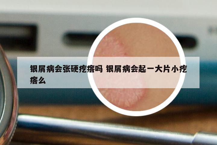 银屑病会张硬疙瘩吗 银屑病会起一大片小疙瘩么