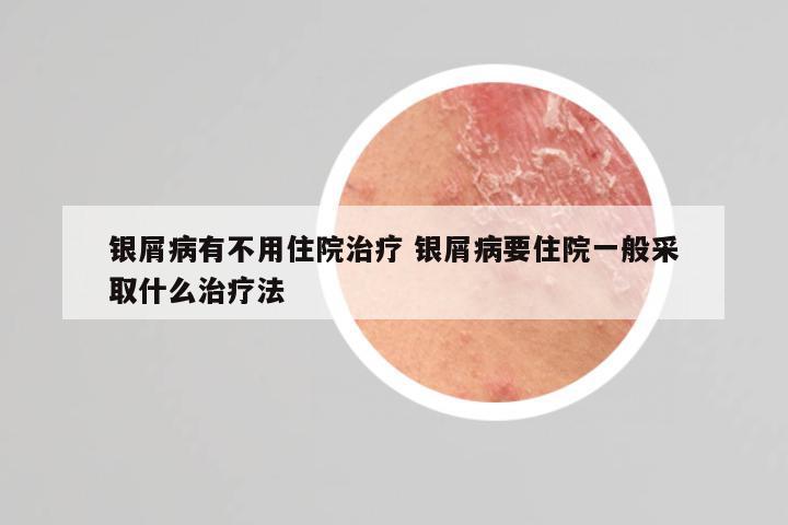 银屑病有不用住院治疗 银屑病要住院一般采取什么治疗法