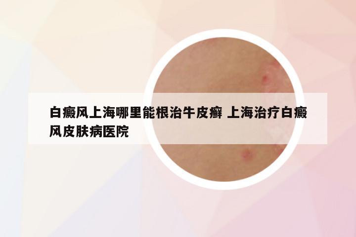 白癜风上海哪里能根治牛皮癣 上海治疗白癜风皮肤病医院