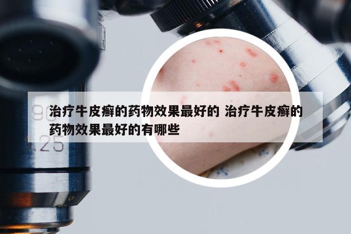 治疗牛皮癣的药物效果最好的 治疗牛皮癣的药物效果最好的有哪些