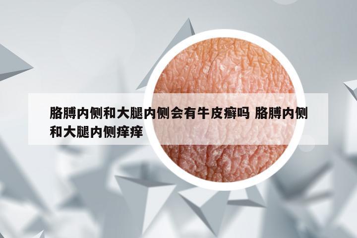 胳膊内侧和大腿内侧会有牛皮癣吗 胳膊内侧和大腿内侧痒痒