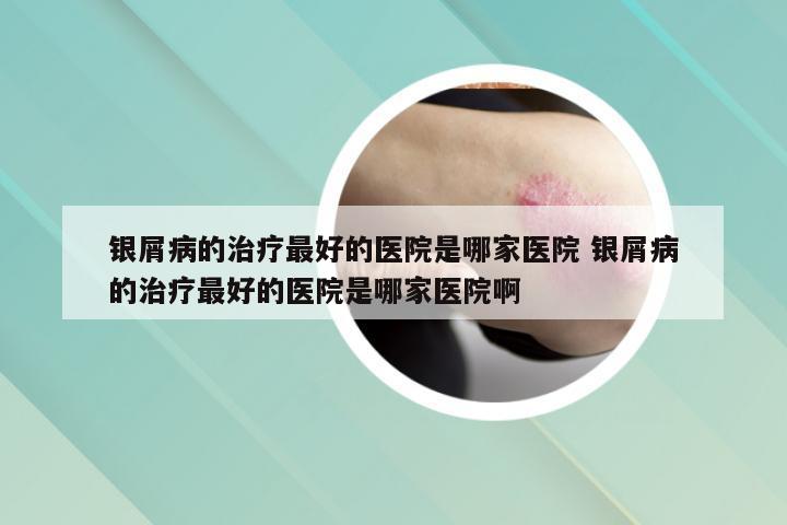 银屑病的治疗最好的医院是哪家医院 银屑病的治疗最好的医院是哪家医院啊