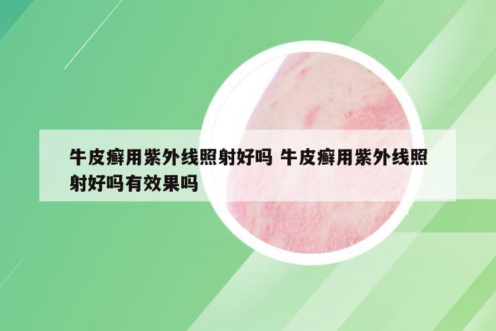 牛皮癣用紫外线照射好吗 牛皮癣用紫外线照射好吗有效果吗