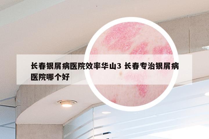 长春银屑病医院效率华山3 长春专治银屑病医院哪个好