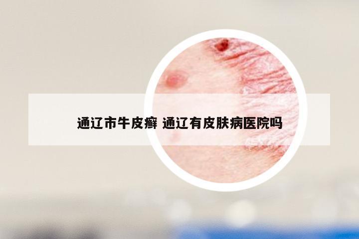 通辽市牛皮癣 通辽有皮肤病医院吗