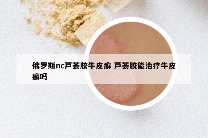 俄罗斯nc芦荟胶牛皮癣 芦荟胶能治疗牛皮癣吗