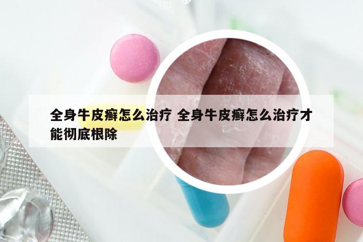 全身牛皮癣怎么治疗 全身牛皮癣怎么治疗才能彻底根除