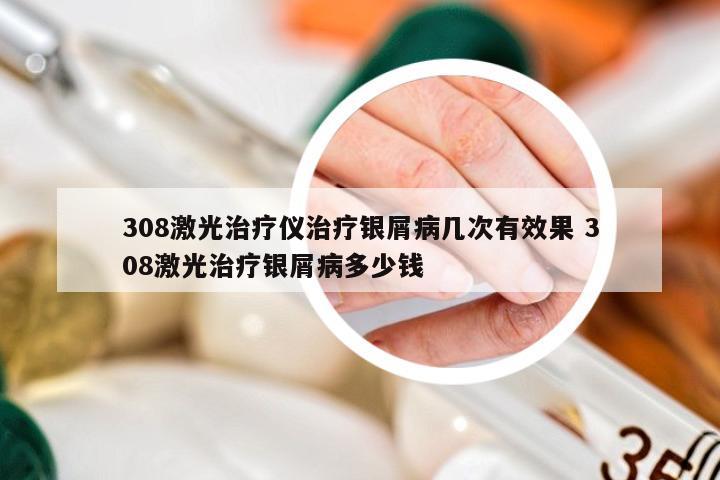 308激光治疗仪治疗银屑病几次有效果 308激光治疗银屑病多少钱