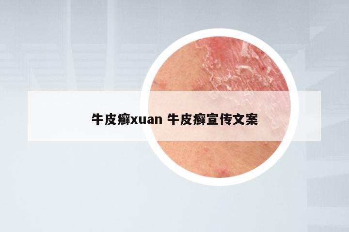 牛皮癣xuan 牛皮癣宣传文案