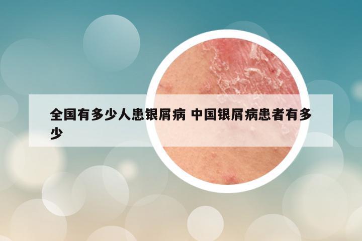 全国有多少人患银屑病 中国银屑病患者有多少