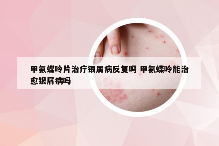 甲氨蝶呤片治疗银屑病反复吗 甲氨蝶呤能治愈银屑病吗