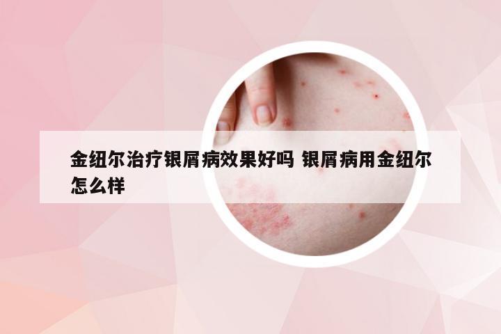 金纽尔治疗银屑病效果好吗 银屑病用金纽尔怎么样