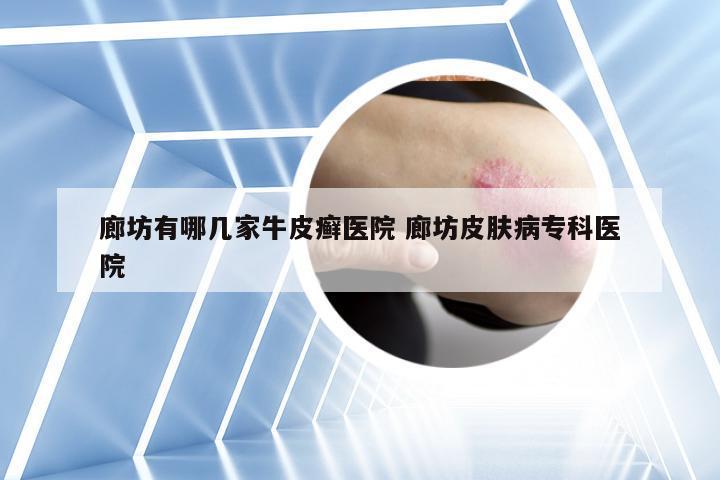 廊坊有哪几家牛皮癣医院 廊坊皮肤病专科医院