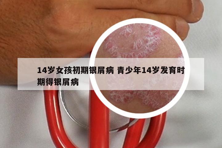 14岁女孩初期银屑病 青少年14岁发育时期得银屑病