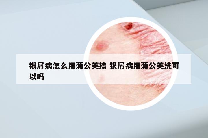 银屑病怎么用蒲公英擦 银屑病用蒲公英洗可以吗