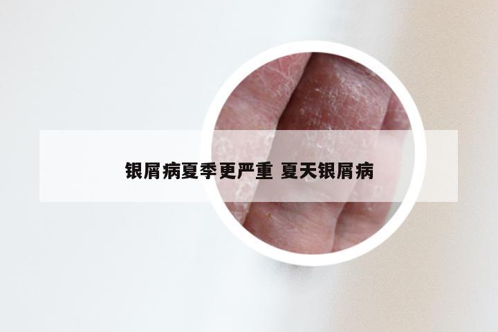 银屑病夏季更严重 夏天银屑病